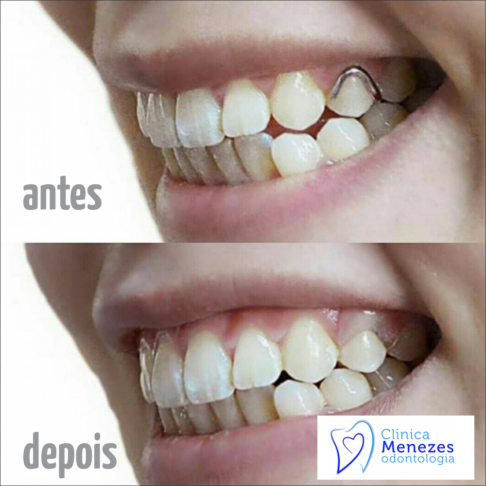 Prótese Dentaria Prótese Removível Prótese Flexível Dr Tadeu Menezes